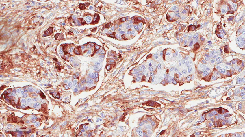 Image showing breast cancer biopsy stained for expression of protein COMP